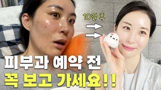 피부과 제일 비싼 시술💆‍♀️ 받아봤다..!!내돈내산💸  찐후기ㅣ쥬베룩, 툴륨, 울쎄라, 써마지